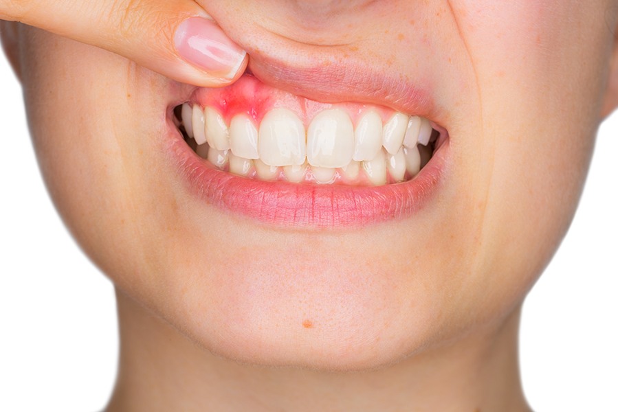 Gum Disease Therapy |Carling Heights Dental Clinic London