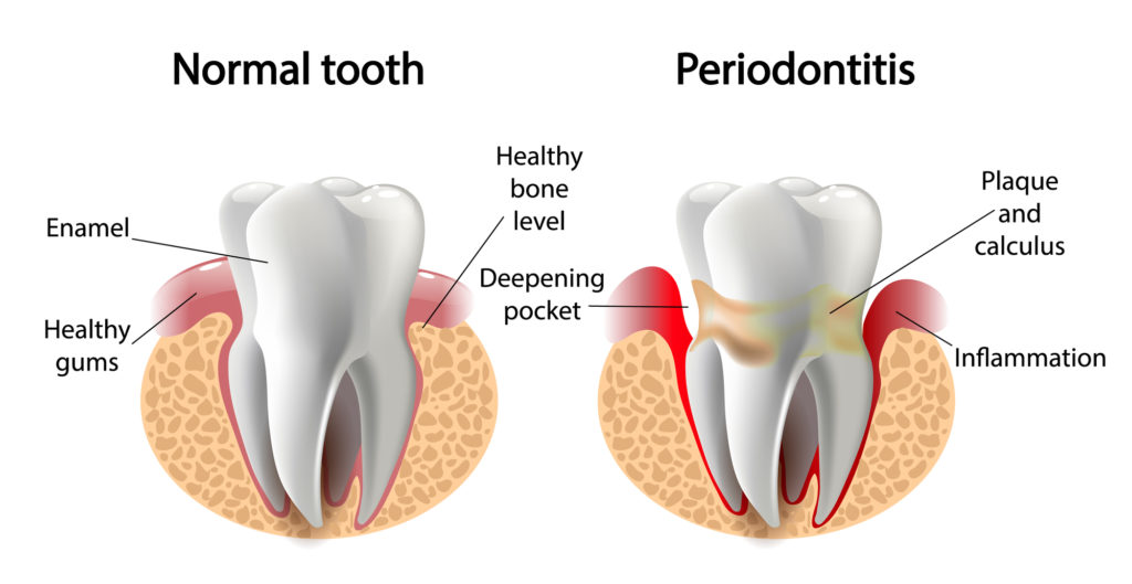 Gum Disease Therapy London | Carling Heights Dental Clinic