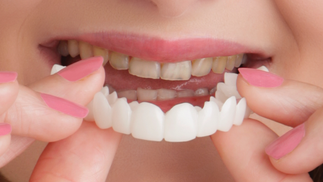 snap on smile | cosmetic dentist in London