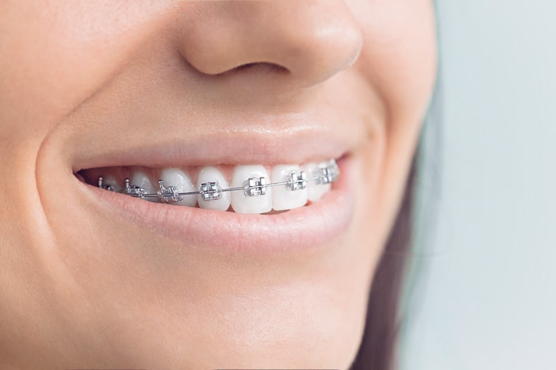 Traditional metal braces | orthodontic treatments london 