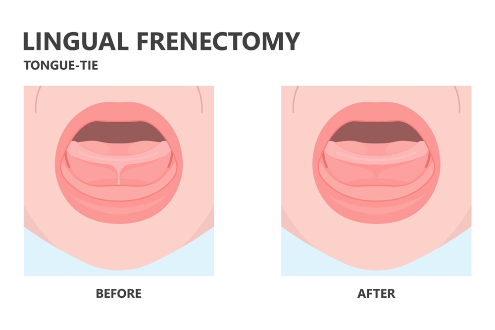 frenectomy in London ON |Carling Heights Dental Clinic 