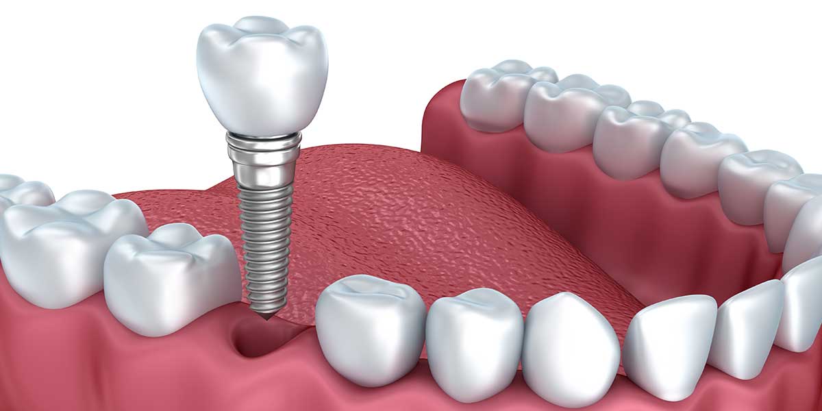 Dental Implants | Oral Surgery London ON | Carling Heights Dental Clinic