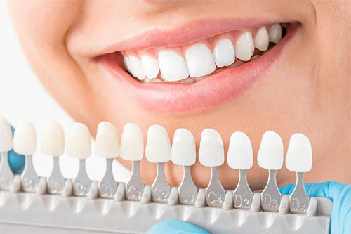 dental veneers in London | Carling Heights Dental Clinic