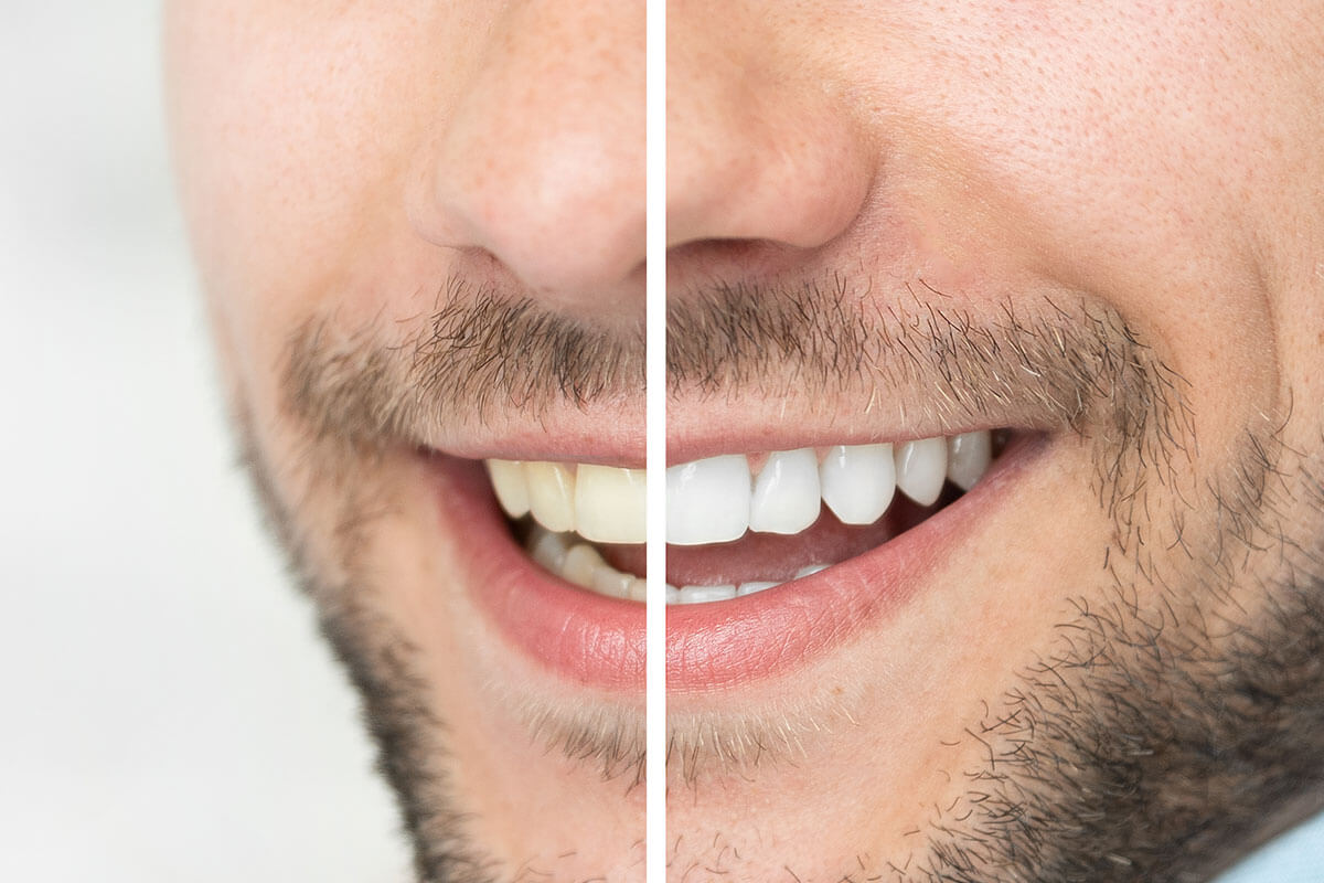 Teeth Whitening in London | Carling Heights Dental Clinic