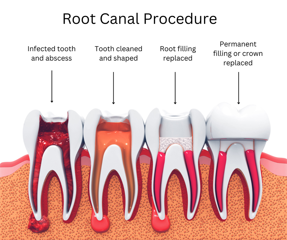 Root canal therapy London | Carling Heights Dental Clinic